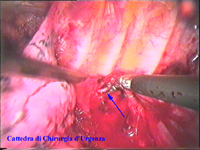 Sono stati posizionati gli strumenti nella cavità pleurica sinistra e si è aperta la pleura parietale. Inizia la dissezione della catena a livello T2-T3. La freccia blu indica la catena.