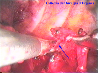 La dissezione viene prolungata verso l'alto fino a identificare il ganglio C8-T1. La freccia blu indica la catena.