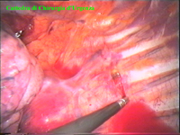 Quando viene identificata la catena gangliare si incide la pleura con un dissettore connesso al coagulatore.