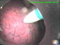 Si inizia la procedura sul lato sinistro. L'introduzione del toracoport sotto controllo visivo.
