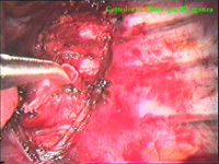 La porzione caudale catena gangliare viene sottesa in direzione mediale dal dissettore.