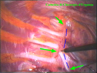 Per trasparenza sollo la pleura parietale viene identificata la catena gangliare (linea blù) per un tratto corrispondente a 2-4 metameri (freccie verdi). Con il dissettore si incide la pleura.