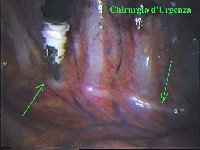 Terminato l’intervento su di un lato si procede nel cavo pleurico controlaterale. Le freccie indicano il decorso della catena gangliare.